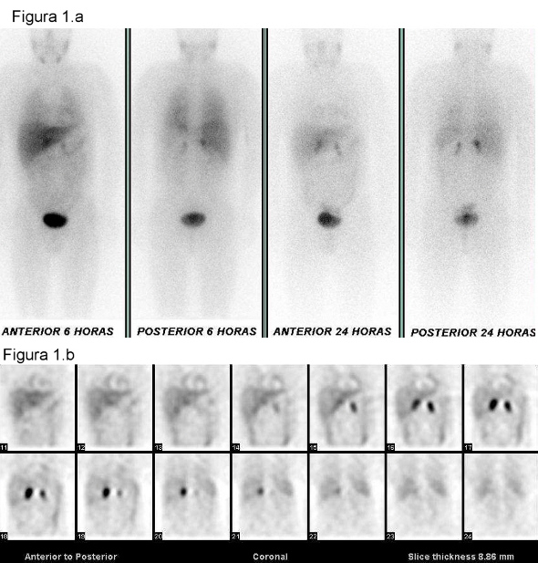 Figura 1:Figura 1.a) El estudio de 123 I-MIBG sobre cuerpo completo, realizado a las 5 y 24 horas, muestra intensa captación patológica en ambas suprarrenales que aumenta en las imágenes tardías. No se observan acúmulos extraadrenales.Figura 1.b) Los cortes coronales del estudio tomográfico realizado a las 24 horas muestran captación patológica de alta intensidad en suprarrenal derecha y de moderada intensidad en la izquierda. Figura 1:Figura 1.a) El estudio de 123 I-MIBG sobre cuerpo completo, realizado a las 5 y 24 horas, muestra intensa captación patológica en ambas suprarrenales que aumenta en las imágenes tardías. No se observan acúmulos extraadrenales.Figura 1.b) Los cortes coronales del estudio tomográfico realizado a las 24 horas muestran captación patológica de alta intensidad en suprarrenal derecha y de moderada intensidad en la izquierda.