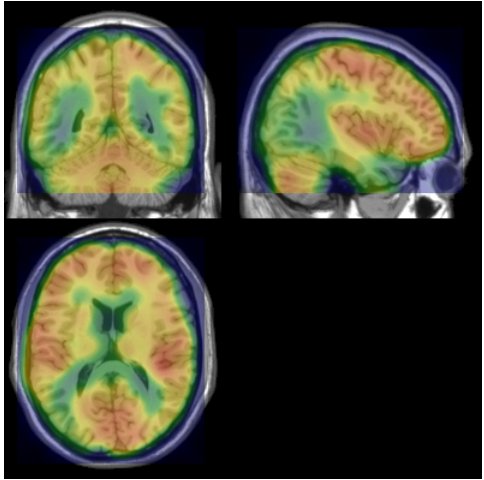Figura 1. Representación en los tres planos de la exploración PET para el paciente. Se aprecia disminución del metabolismo de la FDG en ambas regiones parieto-temporales, más marcada en lado derecho. Figura 1. Representación en los tres planos de la exploración PET para el paciente. Se aprecia disminución del metabolismo de la FDG en ambas regiones parieto-temporales, más marcada en lado derecho.