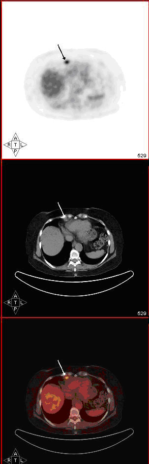 Caso N° 1.PET-CT : Linfonodo hipermetabólico aislado en la cadena mamaria interna Caso N° 1.PET-CT : Linfonodo hipermetabólico aislado en la cadena mamaria interna