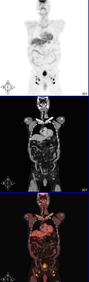Caso N° 2 PET-CT . Múltiplesadenopatías ávidas de 18 FDG inguinales bilaterales. Caso N° 2 PET-CT . Múltiplesadenopatías ávidas de 18 FDG inguinales bilaterales.