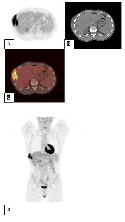 Figura 2. 18 FDG PET-CT. A. PET. Corte transaxial; B. CT sin medio de contraste yodado; C. Fusion PET-CT; D PET. Corte coronal Figura 2. 18 FDG PET-CT. A. PET. Corte transaxial; B. CT sin medio de contraste yodado; C. Fusion PET-CT; D PET. Corte coronal