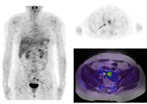 Figura. 1. – Imagen coronal PET-FDG (izquierda) de la paciente número 1, donde se aprecia foco hipermetabólico patológico de FDG en región pélvica medial. Imagen axial PET-FDG (derecha arriba) a la altura de foco patológico. Imagen axial de fusión PET-FDG con RNM en secuencia T1 (derecha abajo) a la altura de foco patológico, que permite una localización anatómica exacta en útero de la misma. Figura. 1. – Imagen coronal PET-FDG (izquierda) de la paciente número 1, donde se aprecia foco hipermetabólico patológico de FDG en región pélvica medial. Imagen axial PET-FDG (derecha arriba) a la altura de foco patológico. Imagen axial de fusión PET-FDG con RNM en secuencia T1 (derecha abajo) a la altura de foco patológico, que permite una localización anatómica exacta en útero de la misma.