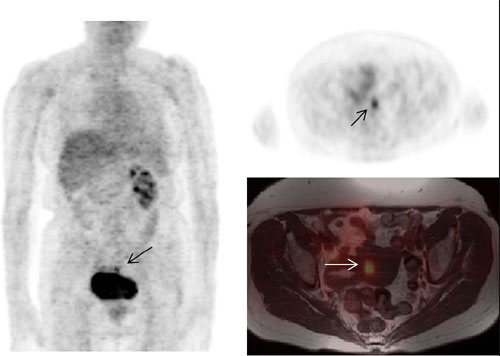 Figura.2. –Imagen coronal PET-FDG (izquierda) de la paciente número 3, donde se aprecia foco hipermetabólico patológico de FDG en región pélvica medial y ausencia de riñón derecho por nefrectomía previa. Imagen axial PET-FDG (derecha arriba) a la altura de foco patológico. Imagen axial de fusión PET-FDG con RNM en secuencia T1 (derecha abajo) a la altura de foco patológico, que permite una localización anatómica exacta en útero de la misma. Figura.2. –Imagen coronal PET-FDG (izquierda) de la paciente número 3, donde se aprecia foco hipermetabólico patológico de FDG en región pélvica medial y ausencia de riñón derecho por nefrectomía previa. Imagen axial PET-FDG (derecha arriba) a la altura de foco patológico. Imagen axial de fusión PET-FDG con RNM en secuencia T1 (derecha abajo) a la altura de foco patológico, que permite una localización anatómica exacta en útero de la misma.