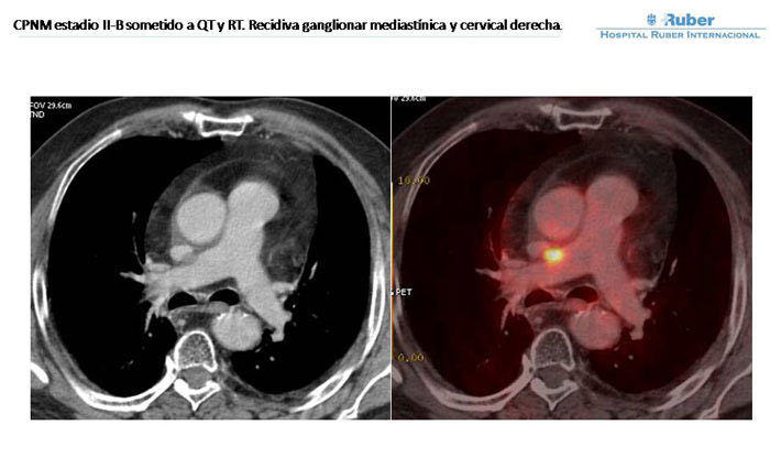 Fig. 1: Adenopatía de 12,9 mm. y metabolismo aumentado (SUV: 11,6) de situación retrocava y por delante de la arteria pulmonar derecha. Fig. 1: Adenopatía de 12,9 mm. y metabolismo aumentado (SUV: 11,6) de situación retrocava y por delante de la arteria pulmonar derecha.