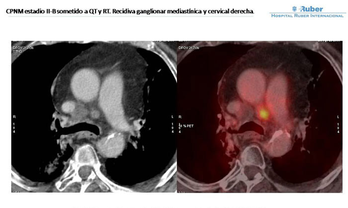 Fig. 2: Adenopatía precarinal de 10,3 mm. captante de FDG (SUV; 6,8). Fig. 2: Adenopatía precarinal de 10,3 mm. captante de FDG (SUV; 6,8).