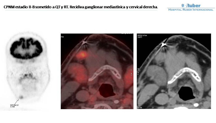 Fig. 4: Adenopatía submandibular derecha (6,1 mm. / SUV: 5,2). Fig. 4: Adenopatía submandibular derecha (6,1 mm. / SUV: 5,2).