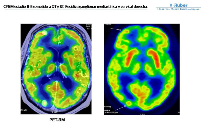 Fig. 5: Metástasis en región frontal derecha y parieto-occipital ipsilateral. Fig. 5: Metástasis en región frontal derecha y parieto-occipital ipsilateral.
