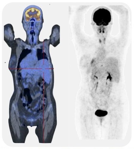 Resultado de imagen de Otro ejemplo importante de tecnología creada en el CERN con aplicaciones a la terapia del cáncer es el Neutron Driven Element Trasmuter.