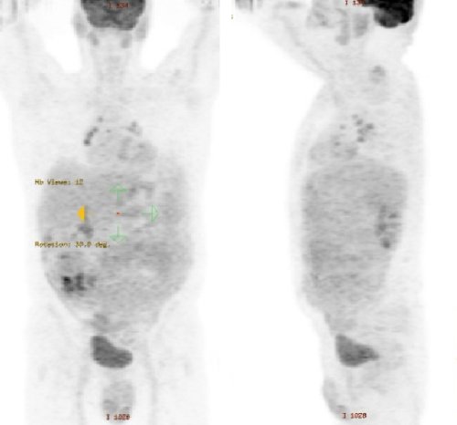 Figura 1. Cortes coronal y sagital de un estudio PET-FDG realizado en uno de los pacientes con PMP. Captación difusa en peritoneo, con clara separación del retroperitoneo en la imagen sagital. Figura 1. Cortes coronal y sagital de un estudio PET-FDG realizado en uno de los pacientes con PMP. Captación difusa en peritoneo, con clara separación del retroperitoneo en la imagen sagital.