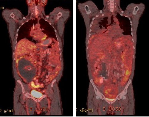 Figura 4. Corte coronal PET/CT de ambos pacientes. Distribución heterogénea de la captación con áreas que no incorporaron FDG, correspondientes a material con alto contenido de mucina. Figura 4. Corte coronal PET/CT de ambos pacientes. Distribución heterogénea de la captación con áreas que no incorporaron FDG, correspondientes a material con alto contenido de mucina.