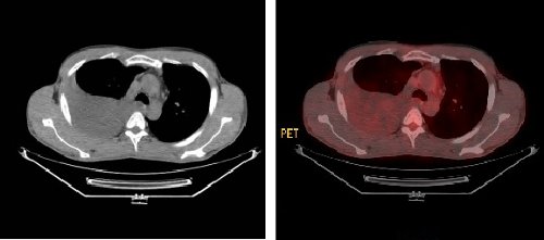 Figura 5. Izquierda, corte axial de CT; derecha, fusión PET/CT. Derrame pleural derecho con captación de 18F-FDG. Figura 5. Izquierda, corte axial de CT; derecha, fusión PET/CT. Derrame pleural derecho con captación de 18F-FDG.