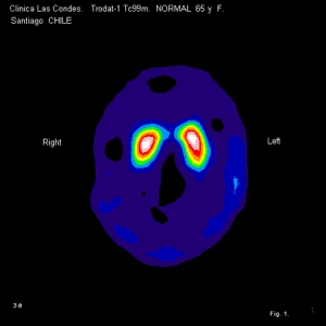 Figura 1. Trodat-1 NeuroSPECT Normal. Mujer de 65 años de edad.