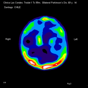 Figura 2. Trodat-1 NeuroSPECT en Enfermedad de Parkinson. Hombre de 69 años de edad con cuadro clínico severo.