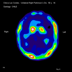 Figura 3. Trodat-1 NeuroSPECT en Hemiparkinsonismo Derecho. Hombre de 50 años de edad.