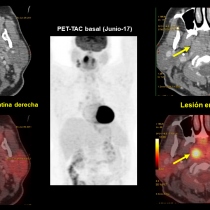 Falsos positivos en la valoración de la respuesta al tratamiento en ...