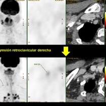 Falsos positivos en la valoración de la respuesta al tratamiento en ...