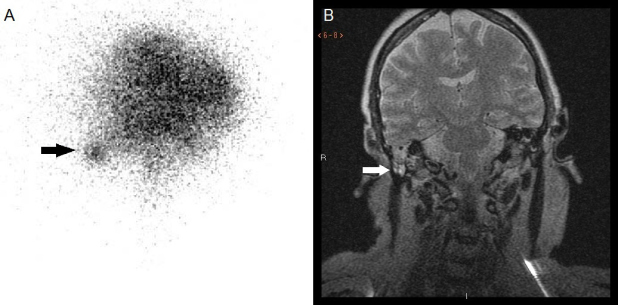 Figura 2. Cisternogammagrafía isotópica con 111In-DTPA (A) y RNM cerebral (B).