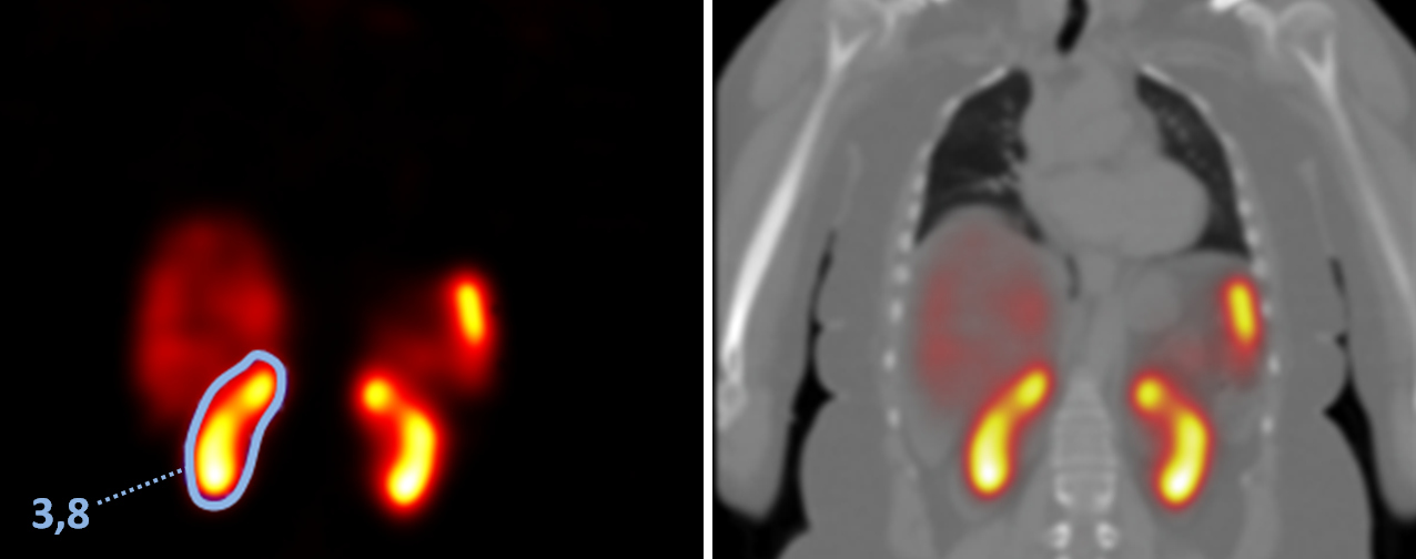 Figura 3. Cortes coronais da imagem paramétrica de dose (Gy) + fusão com CT pelo programa Osirix de paciente submetido à terapia com 177Lu-DOTATATE. Volume de interesse definido sobre o rim para cálculo da dose de 3,8 Gy.