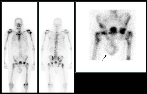 Figura 1. Gammagrafia ósea con Tc-99m-hidroxidifosfonato. Se visualiza zona de hipocaptación con halo hipercaptante en testículo derecho, compatible con hidrocele escrotal (flecha).
