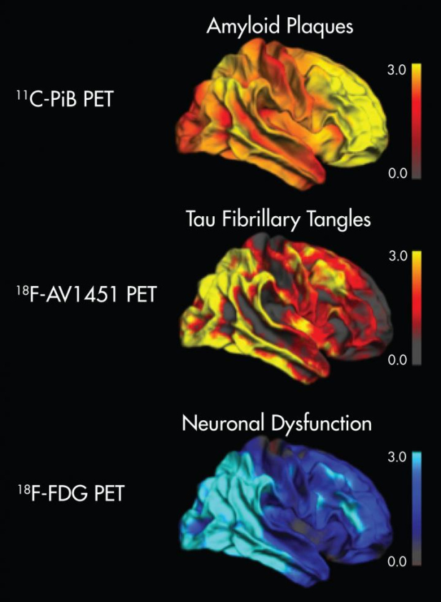 Imagen del año 2016 de la SNMMI para marcadores múltiples en enfermedad de Alzheimer